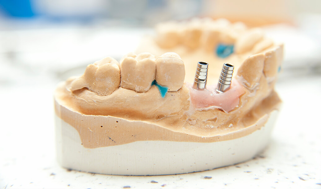 Modell av ett tandimplant